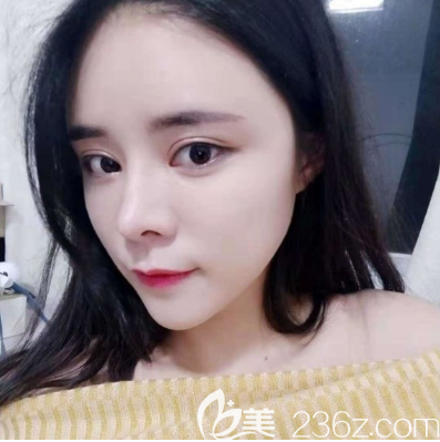 在广州天姿做完脂肪填充全脸术后6天效果图 在广州天姿做完脂肪填充全脸术后6天效果图