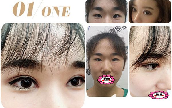 邵阳曹家整形割双眼皮对比图 邵阳曹家整形割双眼皮对比图
