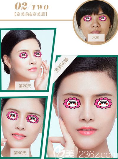 邵阳曹家<!--<i data=20240703-sp></li>
<li><i data=20240703-sp></i>-->医生隆鼻效果图