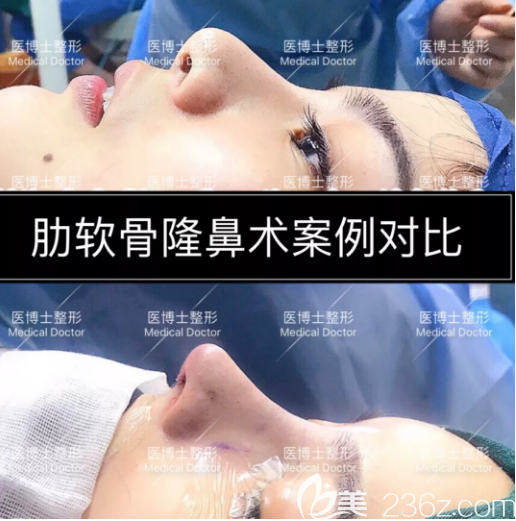 佛山医博士刘哲医生肋软骨隆鼻案例