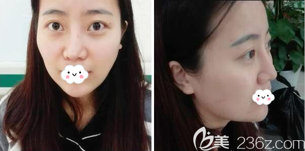 自体脂肪填充术前照片 自体脂肪填充术前照片