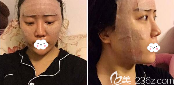 全面部脂肪填充+埋线提升术后即刻 全面部脂肪填充+埋线提升术后即刻