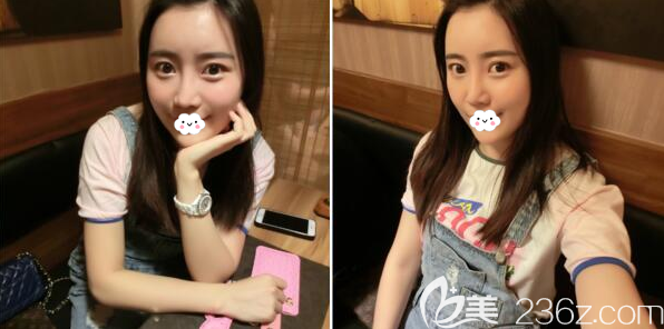 自体脂肪面部填充术后半个月恢复效果 自体脂肪面部填充术后半个月恢复效果