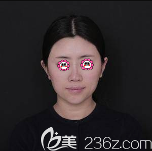 在北京沃尔整形医院做鼻修复前样子 在北京沃尔整形医院做鼻修复前样子