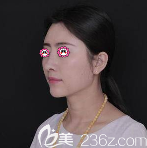 在北京沃尔整形做鼻修复一个多月<span style= 在北京沃尔整形做鼻修复一个多月<span style=