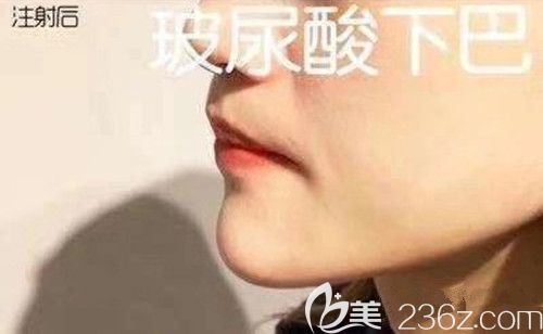 湘潭雅美整形医院玻尿酸丰下巴天