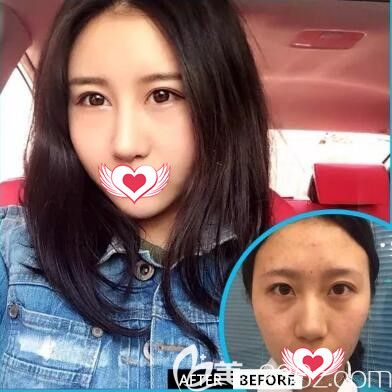 元辰SVF自体脂肪全面部填充真人前后效果对比 元辰SVF自体脂肪全面部填充真人前后效果对比