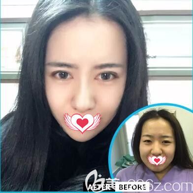 沈阳元辰元生态双眼皮真人前后效果对比 沈阳元辰元生态双眼皮真人前后效果对比