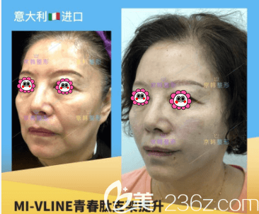 北京京韩张振医生青春肽线雕提升案例 北京京韩张振医生青春肽线雕提升案例