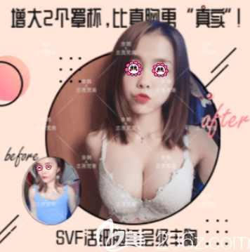 北京京韩王沛森医生SVF活性自体脂肪隆胸案例 北京京韩王沛森医生SVF活性自体脂肪隆胸案例