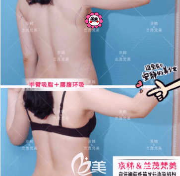 北京京韩王沛森医生手臂+腰腹环吸案例 北京京韩王沛森医生手臂+腰腹环吸案例