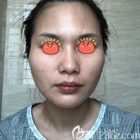 杭州连天美做下颌角手术前 杭州连天美做下颌角手术前