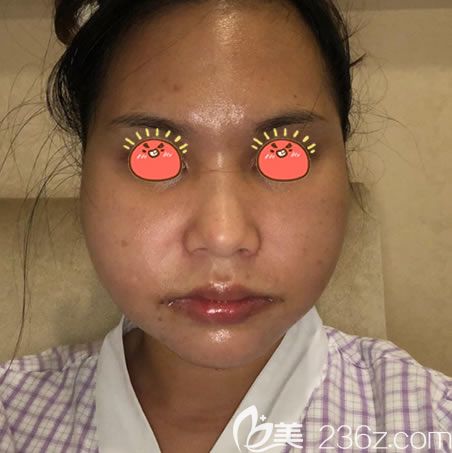 杭州医院刚做完下颌角照片 杭州医院刚做完下颌角照片