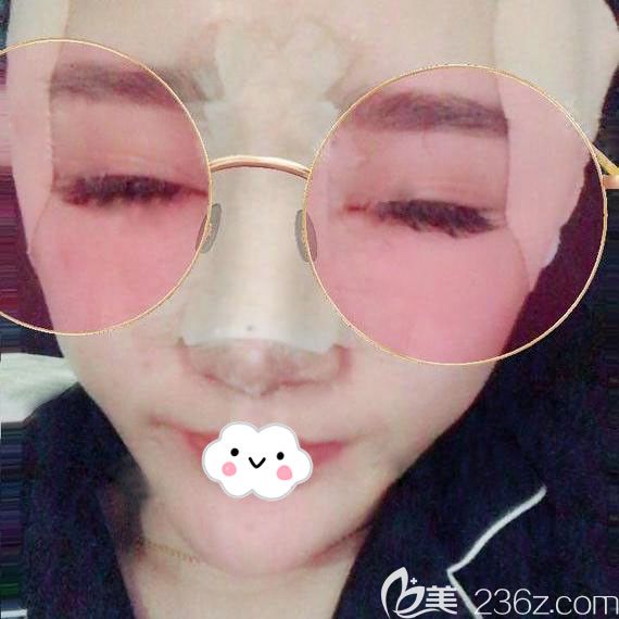 武汉艺星自体脂肪丰面案例效果图