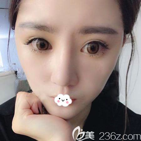 武汉自体脂肪面部填充哪家医院好，武汉艺星案例术后效果图