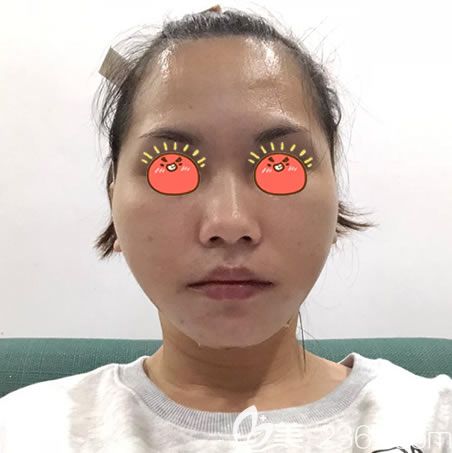 杭州连天美高俊明下颌角案例 杭州连天美高俊明下颌角案例