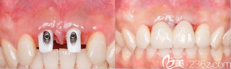 广州圣贝口腔孙世尧门牙种植效果对比图 广州圣贝口腔孙世尧门牙种植效果对比图