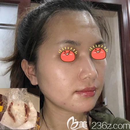 杭州连天美下颌角案例40天效果 杭州连天美下颌角案例40天效果