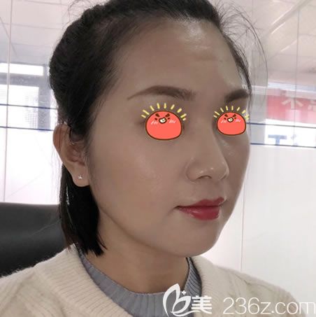 杭州连天美整形下颌角案例 杭州连天美整形下颌角案例