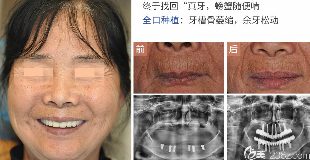 胡晓文医生全口牙种植案例效果对比图