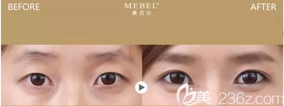 梁志伟医生双眼皮对比案例 梁志伟医生双眼皮对比案例