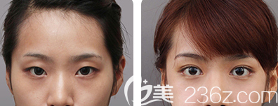 刁金兰双眼皮案例