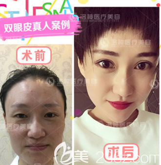 许川医生双眼皮案例