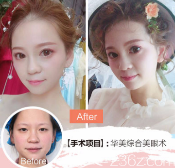 裴彦鹏医生双眼皮案例