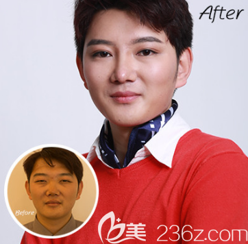 魏璐医生双眼皮案例