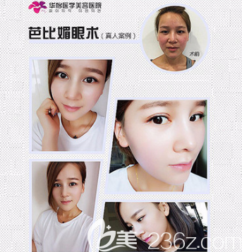 张苹医生双眼皮案例