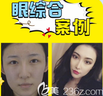 王玉珍医生双眼皮案例