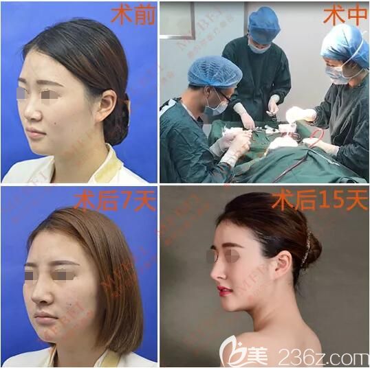 23岁的黄小姐到苏州美贝尔做MEBEL®天然鼻蜕变 23岁的黄小姐到苏州美贝尔做MEBEL®天然鼻蜕变