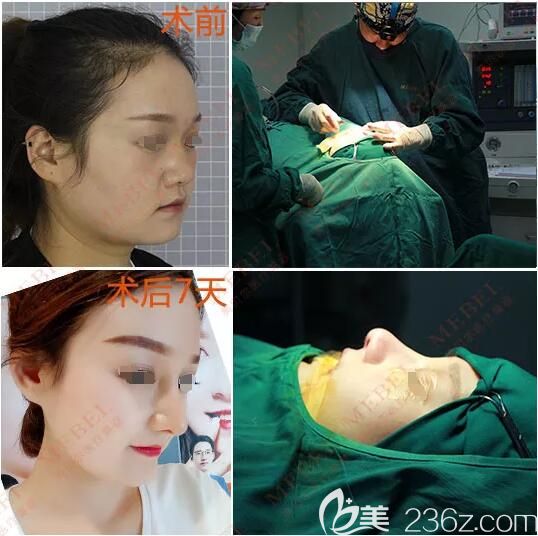 26岁的赵小姐到苏州美贝尔做自体软骨鼻综合 26岁的赵小姐到苏州美贝尔做自体软骨鼻综合