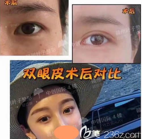 赣州叶子整形医院全切双眼皮前后对比照片 赣州叶子整形医院全切双眼皮前后对比照片