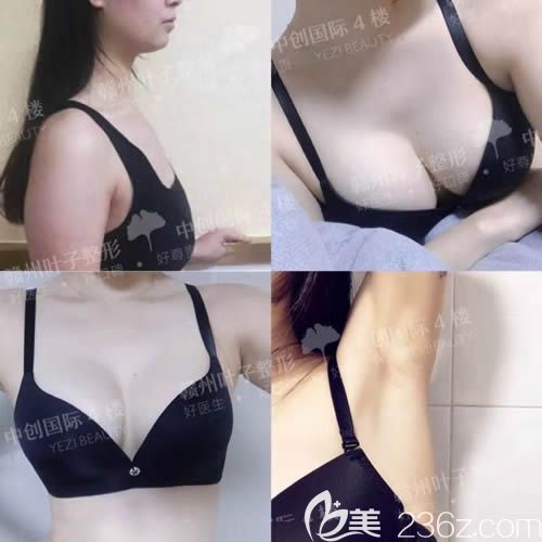 赣州叶子医疗美容假体隆胸<sp前后对比照片 赣州叶子医疗美容假体隆胸<sp前后对比照片