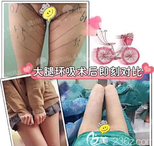 赣州叶子整形医院大腿吸脂前后对比照 赣州叶子整形医院大腿吸脂前后对比照