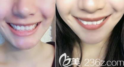 北京美莱王凯医生隐形牙齿矫正案例 北京美莱王凯医生隐形牙齿矫正案例