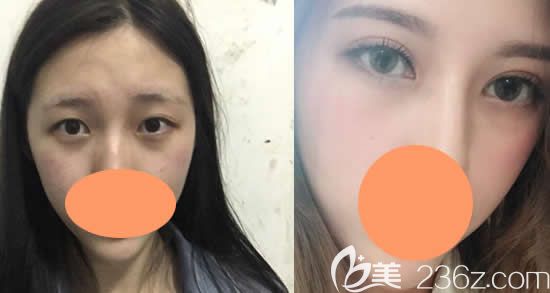 景德镇圣嘉丽割双眼皮案例效果图展示 景德镇圣嘉丽割双眼皮案例效果图展示