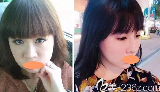 景德镇圣嘉丽整形好不好?刘志强双眼皮祛斑等案例效果及价格表分享给大家看