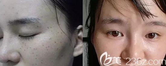 景德镇圣嘉丽激光祛斑真人案例效果前后对比图 景德镇圣嘉丽激光祛斑真人案例效果前后对比图