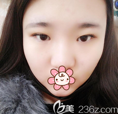 去<i data-id='7cc5e2dd-54d7-4e0e-bdbc-263b227ff84a' style='display:none;'></i>做眼睛前的素颜照片 去<i data-id='7cc5e2dd-54d7-4e0e-bdbc-263b227ff84a' style='display:none;'></i>做眼睛前的素颜照片