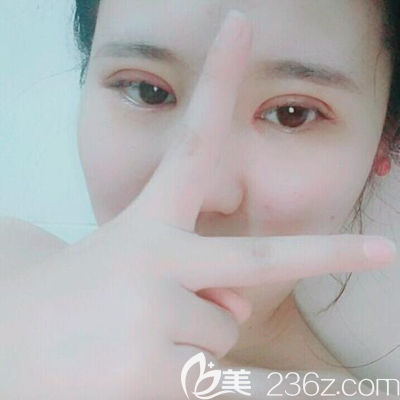 <i data-id='7cc5e2dd-54d7-4e0e-bdbc-263b227ff84a' style='display:none;'></i>眼综合术后即刻 <i data-id='7cc5e2dd-54d7-4e0e-bdbc-263b227ff84a' style='display:none;'></i>眼综合术后即刻