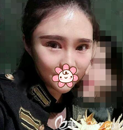 双眼皮开眼角术后7天拆线效果 双眼皮开眼角术后7天拆线效果