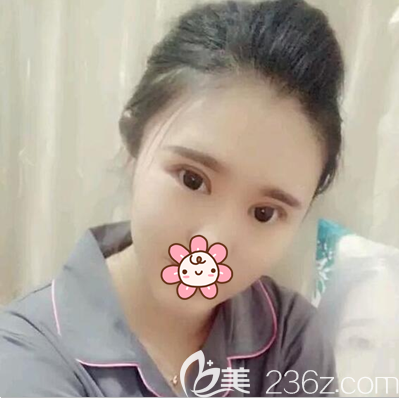 张作香双眼皮开眼角加提肌术后半个月 张作香双眼皮开眼角加提肌术后半个月