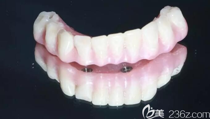 全口种植所用牙冠 全口种植所用牙冠