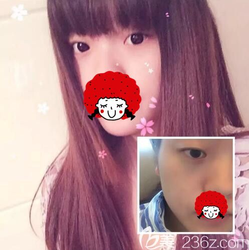 面诊聂志宏医生术前单眼皮 面诊聂志宏医生术前单眼皮