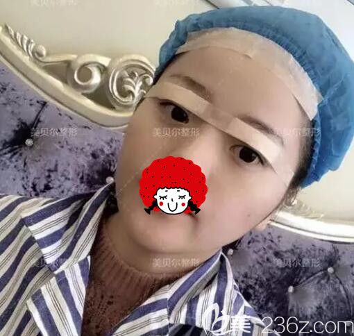 刚做完埋线法双眼皮+上睑下垂矫正的眼部整形手术术后即刻 刚做完埋线法双眼皮+上睑下垂矫正的眼部整形手术术后即刻