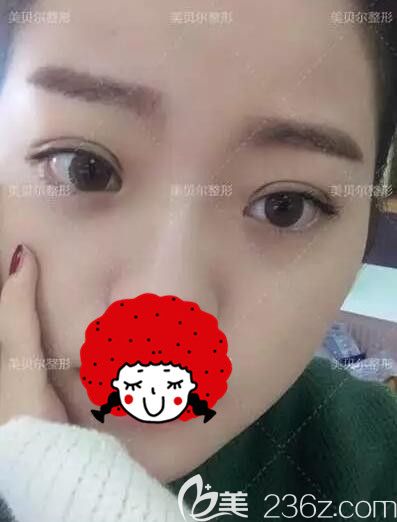 术后一周埋线法双眼皮+上睑下垂矫正的眼部整形手术恢复中 术后一周埋线法双眼皮+上睑下垂矫正的眼部整形手术恢复中