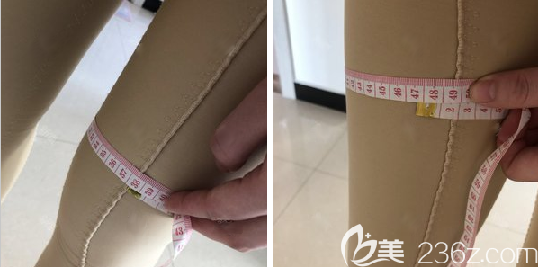 术后帮个月测量腿围小了7CM 术后帮个月测量腿围小了7CM