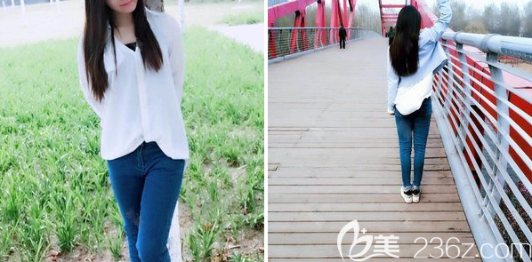 <!--<i data=20240703-sp></i>-->大腿吸脂一个月恢复情况 <!--<i data=20240703-sp></i>-->大腿吸脂一个月恢复情况